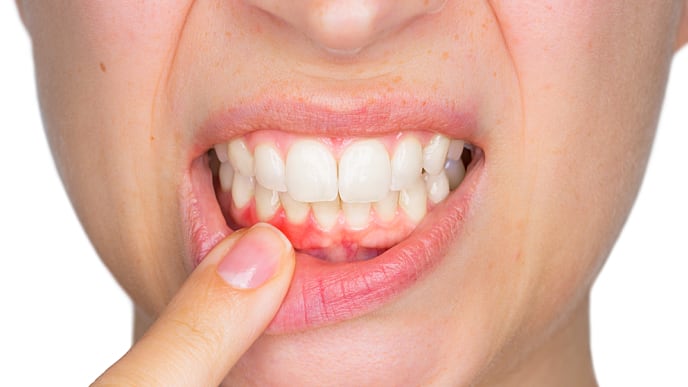 enfermedad periodontal provocada por infecciones bacterianas