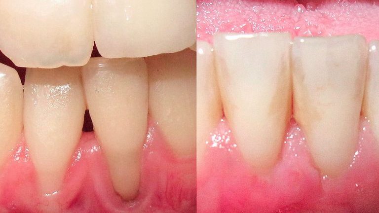 tratamiento periodontal antes y después