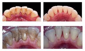 periodontitis curada antes y despues